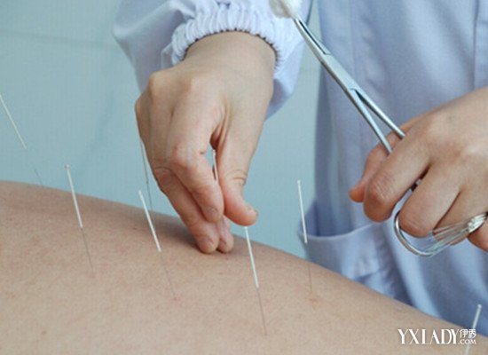 acupuncture pdf_acupuncture pdf_acupuncture pdf